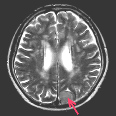 脳MRI断面像T2強調画像