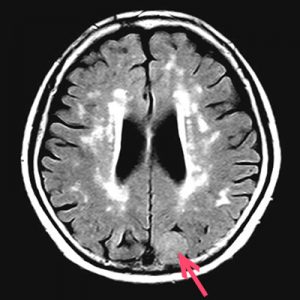 脳MRI断面像フレアー画像