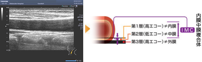 頚動脈超音波検査 動脈硬化の程度