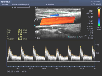頚動脈超音波検査 頚動脈血流計測