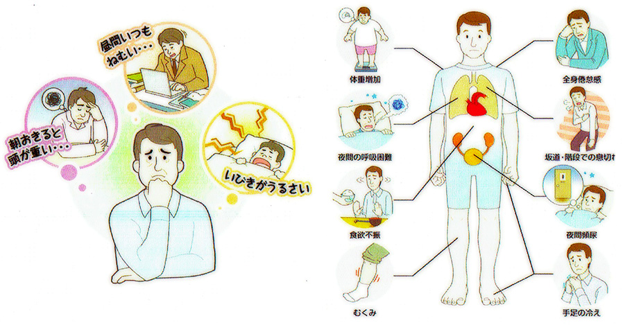 睡眠時無呼吸症候群の症状