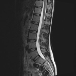 腰椎ドックMRI画像