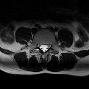 腰椎ドックMRI画像