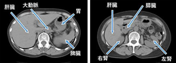 相馬郡新地町渡辺病院の腹部CT検査輪切り断面画像