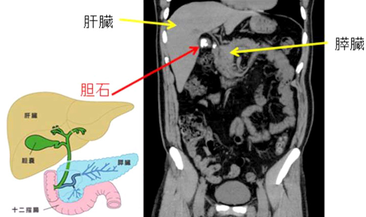 相馬郡新地町渡辺病院の腹部CT検査縦切り断面画像